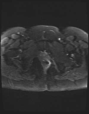 Class II Mullerian duct anomaly- unicornuate uterus with rudimentary horn and non-communicating cavity (Radiopaedia 39441-41755 Axial DWI 26).jpg