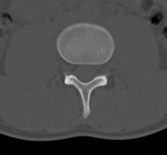 Clear cell meningoma - lumbar spine (Radiopaedia 60116-67691 Axial bone window 41).png