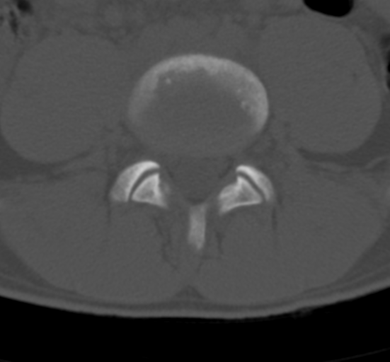 Clear cell meningoma - lumbar spine (Radiopaedia 60116-67691 Axial bone window 55).png