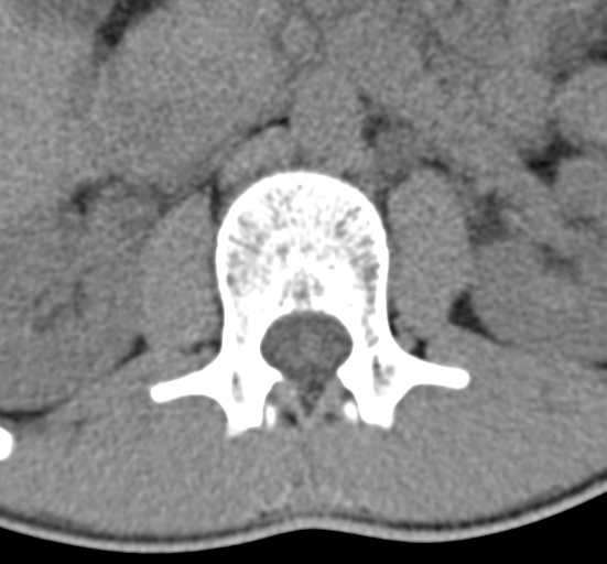 Clear cell meningoma - lumbar spine (Radiopaedia 60116-67691 Axial non-contrast 14).png