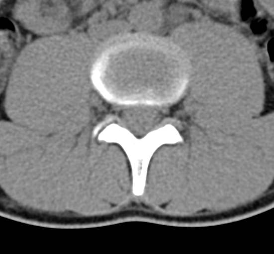 Clear cell meningoma - lumbar spine (Radiopaedia 60116-67691 Axial non-contrast 43).png