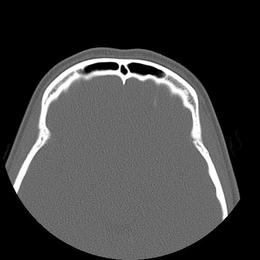 File:Cleft hard palate and alveolus (Radiopaedia 63180-71710 Axial bone window 27).jpg