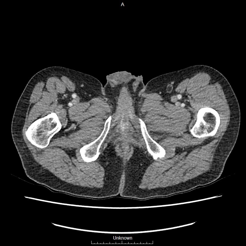 Closed loop bowel obstruction and ischemia (Radiopaedia 86959-103180 A 100).jpg