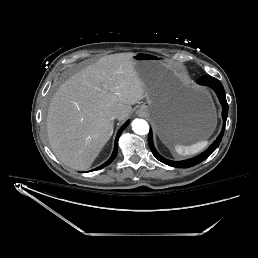 File:Closed loop obstruction due to adhesive band, resulting in small bowel ischemia and resection (Radiopaedia 83835-99023 Axial 327).jpg