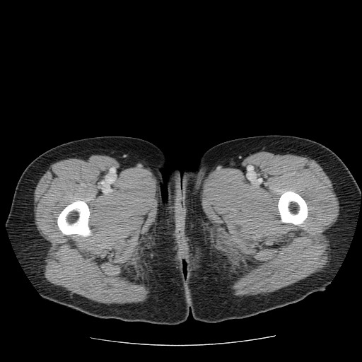 File:Closed loop small bowel obstruction (Radiopaedia 65403-74451 A 91).jpg