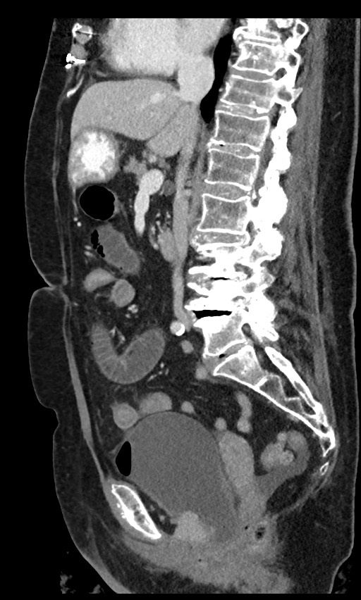 Closed loop small bowel obstruction - adhesions (Radiopaedia 59269-66611 C 61).jpg