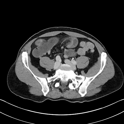 Closed loop small bowel obstruction - internal hernia (Radiopaedia 57806-64778 B 88).jpg