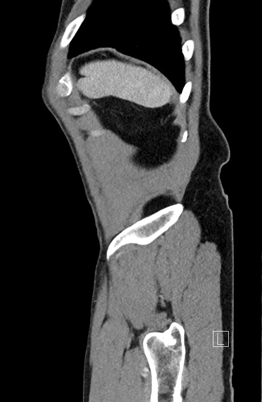 Closed loop small bowel obstruction - internal hernia (Radiopaedia 57806-64778 C 16).jpg
