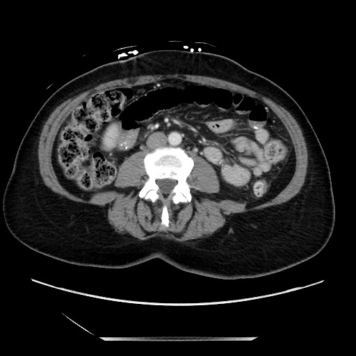 Closed loop small bowel obstruction due to adhesive bands - early and late images (Radiopaedia 83830-99014 A 77).jpg