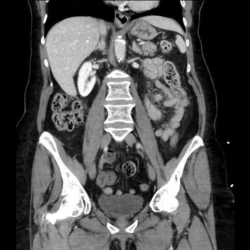 File:Closed loop small bowel obstruction due to adhesive bands - early and late images (Radiopaedia 83830-99014 B 69).jpg