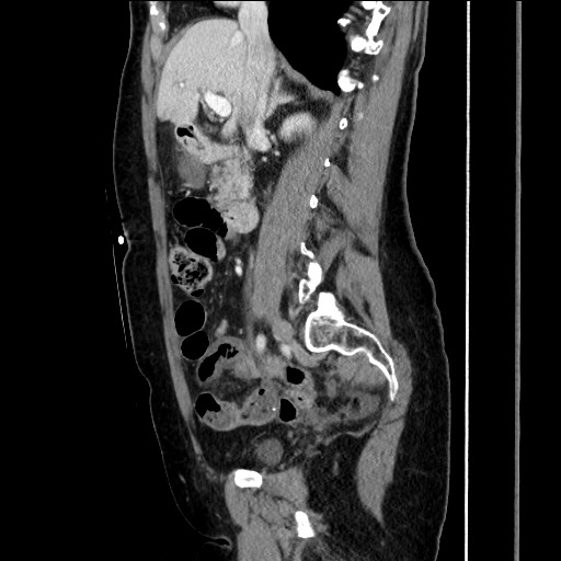 File:Closed loop small bowel obstruction due to adhesive bands - early and late images (Radiopaedia 83830-99014 C 78).jpg