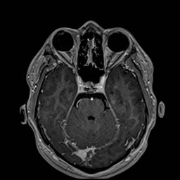 Cochlear incomplete partition type III associated with hypothalamic hamartoma (Radiopaedia 88756-105498 Axial T1 C+ 75).jpg
