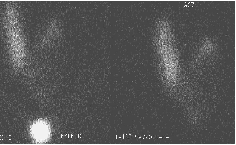 File:Cold nodule on nuclear thyroid scan (Radiopaedia 7351).jpg