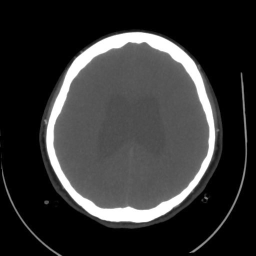 File:Colloid cyst (resulting in death) (Radiopaedia 33423-34499 A 39).png