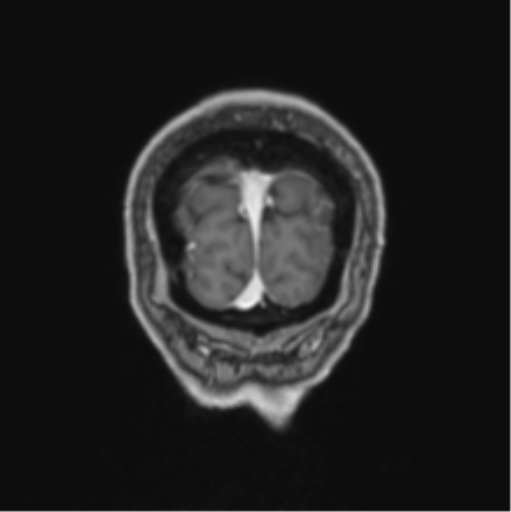 Colloid cyst of the third ventricle (Radiopaedia 86571-102662 Coronal T1 C+ 9).png
