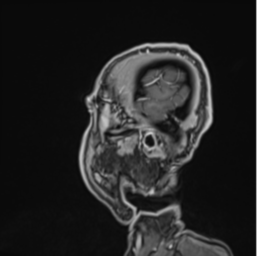 Colloid cyst of the third ventricle (Radiopaedia 86571-102662 Sagittal T1 C+ 71).png