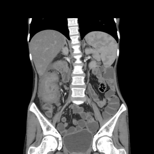 File:Colocolic fistula - Crohn disease (Radiopaedia 57063-63955 B 24).jpg