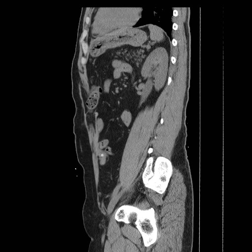 File:Colocutaneous fistula in Crohn's disease (Radiopaedia 29586-30093 C 40).jpg