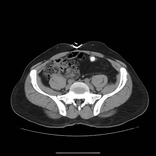 File:Colocutaneous fistula in Crohn's disease (Radiopaedia 29586-30093 D 23).jpg