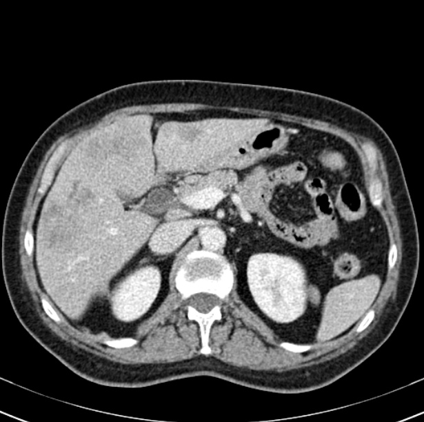 Colon carcinoma with hepatic metastases (Radiopaedia 29477-29961 A 36).jpg