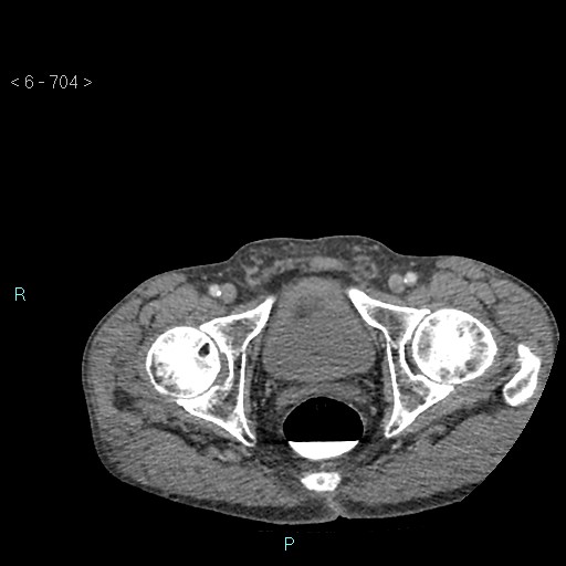 File:Colonic cancer (ultrasound and TC imaging) (Radiopaedia 50346-55713 A 140).jpg