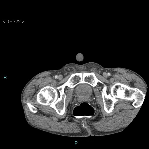 File:Colonic cancer (ultrasound and TC imaging) (Radiopaedia 50346-55713 A 148).jpg