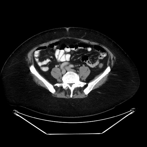 File:Colonic intussusception due to adenocarcinoma (Radiopaedia 86828-102987 Axial 28).jpg