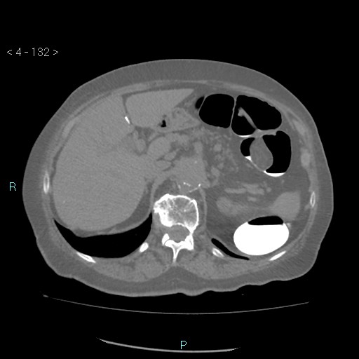 Colonic lipomas (Radiopaedia 49137-54244 Axial bone window 60).jpg