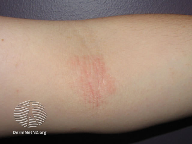 File:Elbow crease (DermNet NZ dermatitis-atopic33).jpg