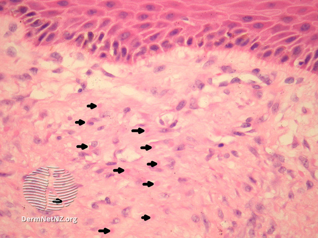 File:Figure 2 (DermNet NZ pathology-e-infantile-digital-fibromatosis-figure-2).jpg