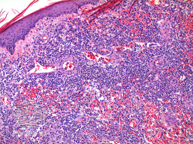 File:Figure 3 (DermNet NZ pathology-t-lypfigure3).jpg