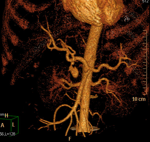 File:Gastroduodenal artery pseudoaneurysm (Radiopaedia 5797).jpg