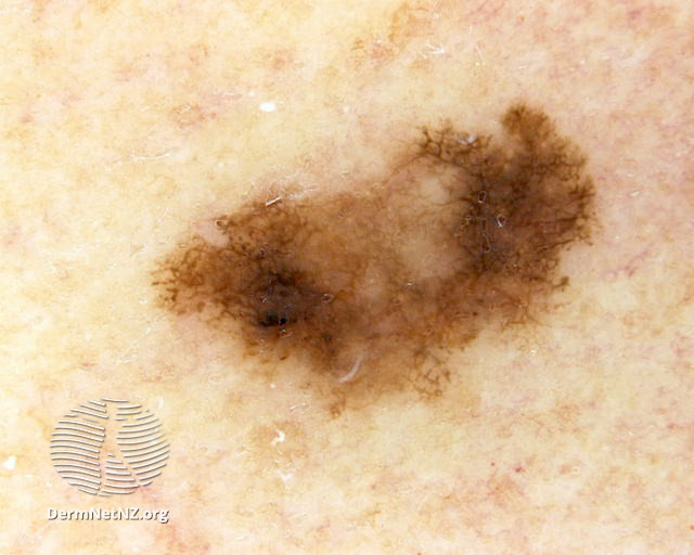 File:Melanoma in situ, polarised dermoscopy view (DermNet NZ 109163).jpg