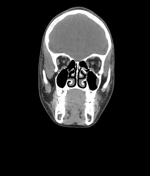 Nasal pyogenic granuloma (lobular capillary hemangioma) (Radiopaedia 85536-101244 Coronal non-contrast 89).jpg