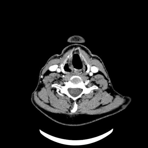 File:Nasopharyngeal carcinoma - infiltrating the clivus (Radiopaedia 62583-70875 Axial Post contrast 53).jpg