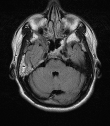 File:Nasopharyngeal carcinoma with pterygopalatine fossa involvement (Radiopaedia 33102-34134 Axial FLAIR 7).png