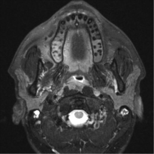File:Nasopharyngeal carcinoma with pterygopalatine fossa involvement (Radiopaedia 33102-34134 Axial T2 13).png