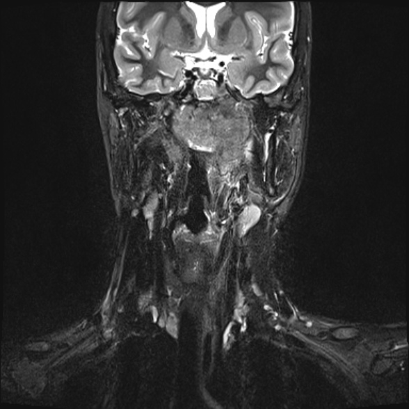 Nasopharyngeal carcinoma with skull base invasion (Radiopaedia 53415-59485 Coronal T2 fat sat 19).jpg