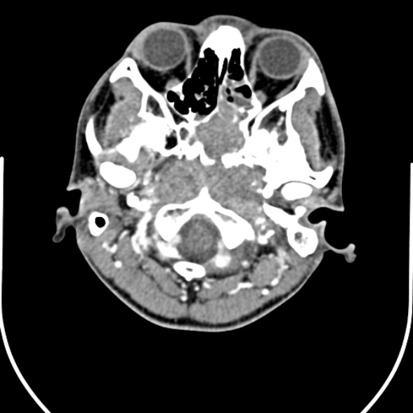 Nasopharyngeal carcinoma with skull base invasion (Radiopaedia 53415-59705 A 29).jpg