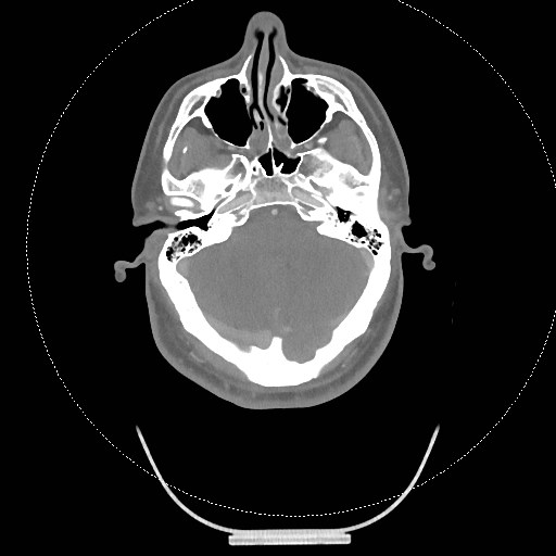 Neck CT angiogram (intraosseous vascular access) (Radiopaedia 55481-61945 B 272).jpg