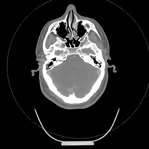 Neck CT angiogram (intraosseous vascular access) (Radiopaedia 55481-61945 B 275).jpg