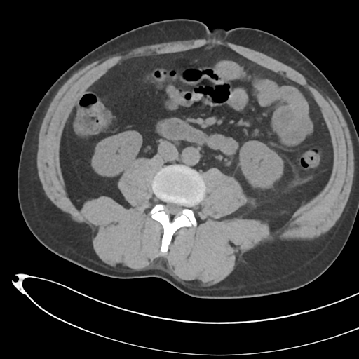 File:Necrotizing pancreatitis with acute necrotic collections (Radiopaedia 38829-41012 Axial non-contrast 45).png