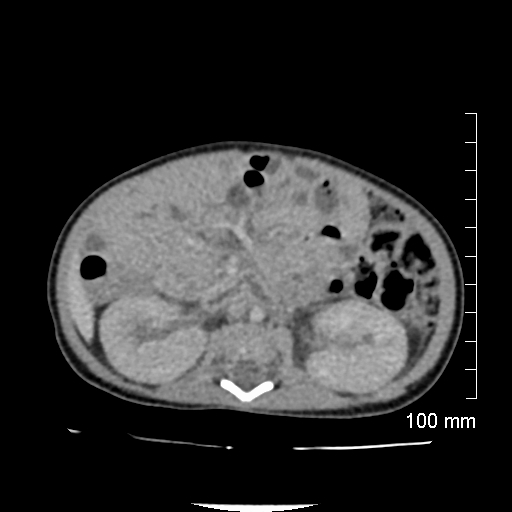 File:Neonatal neuroblastoma (Radiopaedia 56651-63438 Axial non-contrast 42).jpg