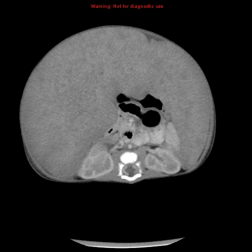 File:Neonatal neuroblastoma (Radiopaedia 9564-10223 A 29).jpg