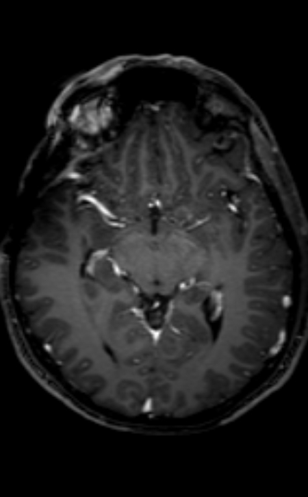 Neuro-Behçet disease (Radiopaedia 90112-107294 Axial T1 C+ 139).jpg