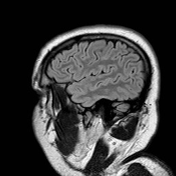File:Neuro-Behcet's disease (Radiopaedia 21557-21506 Sagittal FLAIR 4).jpg