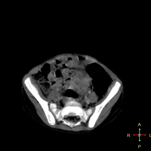 File:Neuroblastoma (Radiopaedia 24751-25016 D 32).jpg