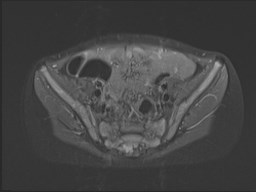 File:Neuroblastoma with bone metastases (Radiopaedia 67080-76414 Axial STIR 56).jpg