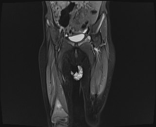 File:Neuroblastoma with bone metastases (Radiopaedia 67080-76414 Coronal STIR 7).jpg