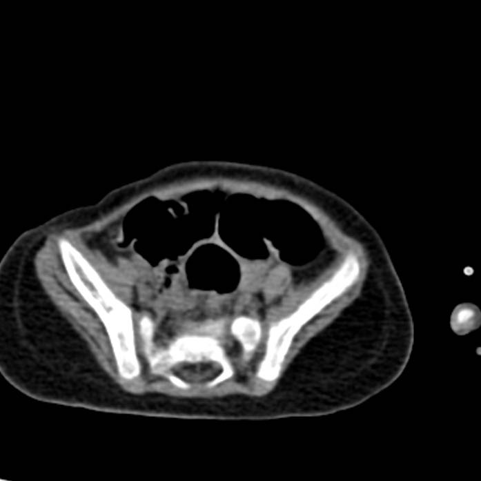 Neuroblastoma with skull metastases (Radiopaedia 30326-30960 Axial non-contrast 48).jpg